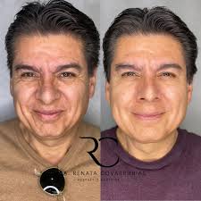 Full Face BOTOX🙌🏻 La Toxina Botulínica tipo A conocida como "Botox" nos  ayuda a tener expresiones relajadas, nos aporta luminosidad dando a nuestra  piel un aspecto fresco y natural✨ Vemos el resultado