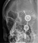 Ventriculoperitoneal Shunt Radiology Reference Article Radiopaedia Org Vp Shunt Brain Surgery Radiology