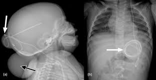 A Shunt Series Showing Coiled Top Part Of Distal Catheter Around The Download Scientific Diagram