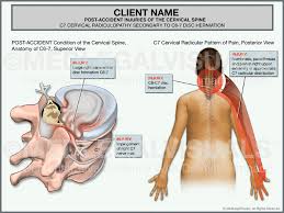 Divides the body or any of its parts into right and left sides. Cervical Radiculopathy After A Car Accident Premier Law Group