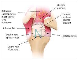 The shoulder joint (glenohumeral joint) is a ball and socket joint between the scapula and the humerus. Diagram From Superolateral View Of A Left Shoulder Illustrating The Fi Download Scientific Diagram