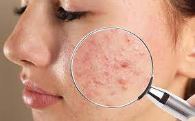 Learn how to quickly and effectively get rid of blind pimples (under skin pimples). How To Treat Your Blind Pimples With Ayurveda Vedix