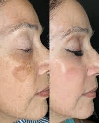 In Jamaica we have a saying “prevention betta dan cure.” We know this to be  true in so many aspects of life, now even more so in skin health. This is  what