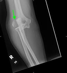 The rounded protuberance at the end of a bone which is most often part of a joint or an attachment with another bone is called condyle. Lateral Epicondyle Fracture Jetem