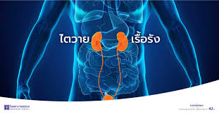 ภาวะที่ไตมีการเสื่อมหน้าที่ลง ไม่สามารถขับของเสีย สารน้ำและเกลือแร่ส่วนเกินออกจากร่างกายได้ ผู้ป่วยอาจมีอาการคลื่นไส้ อาเจียน อ่อนเพลีย. à¹„à¸•à¸§à¸²à¸¢à¹€à¸£ à¸­à¸£ à¸‡ à¸„à¸§à¸²à¸¡à¹€à¸ª à¸¢à¸‡à¸— à¸„à¸™à¸Šà¸­à¸šà¸ à¸™à¹€à¸„ à¸¡à¸„à¸§à¸£à¸£à¸°à¸§ à¸‡