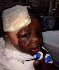 Mother Says Daycare Lied Called Baby S Burns A Fever Cbs Miami
