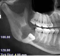 What impacts the cost of wisdom teeth extractions? Wisdom Teeth Wellington Nz Third Molars