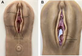 Image result for Bartholin's gland abscess