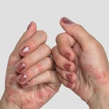 Image result for psoriasis