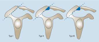 •morphologie des akromions (typ 3 nach bigliani). Figure 2 Impingement Syndrome Der Schulter Springerlink