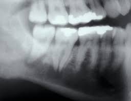 The tumor may extend into other bone tissue nearby like muscle or fat. Metastases To The Mouth And Jaws A Contemporary Canadian Experience Jcda