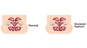 The septum is straight and the inferior turbinate has a characteristic puffy appearance. Deviated Nasal Septum Causes Symptoms Treatments