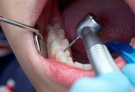 Image result for root canal