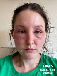 Co2 Laser Recovery Swelling Tip