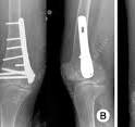 The Surgical Treatment of Distal Femur Medial Condyle ...