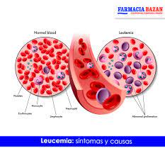 We did not find results for: Farmacia Bazan La Leucemia Es El Cancer De Los Tejidos Que Forman La Sangre En El Organismo Incluso La Medula Osea Y El Sistema Linfatico Existen Muchos Tipos De Leucemia Algunas