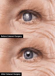 The average cost of a cataract surgery can be anywhere between rs.15,000 to rs.65,000. Cataract Eye Surgery Wolfe Eye Clinic