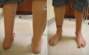 On its caudal part is flat groove called the malleolar groove, for the tendon of flexor digitorum (digitalis) muscle (and caudal tibial. 229 The Answer Should Podiatrists Provide Free Care