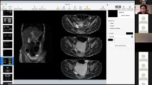Cystic mesothelioma is a rare benign neoplasm of the peritoneum, unrelated to malignant peritoneal radiology 170 : Zebra Alert Benign Cystic Mesothelioma Dr Alina Makoyeva Youtube