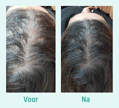 Preventing Gray Hair Neofollics Anti Gray Hair Tablets