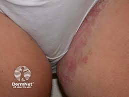 Image result for sore skin in the groin area