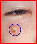 ملف كامل بل صور عن الجديري المائي العنقز chickenpox varicella