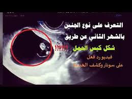 تحديد نوع الجنين بالشهر الثاني عن طريق شكل كيس الحمل فيديو رد فعل على سونار وكشف الخدعة Youtube