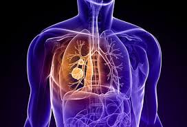 Development and function of the lung alveoli: Lung Cancer Signs Symptoms Stages Treatment Survival Rate