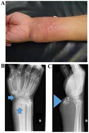 Image result for phlegmon of hand)