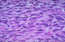 Image result for Leiomyosarcoma