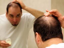 Corak kebotakan rambut lelaki walaupun ada banyak sebab berbeza mengenai keguguran rambut, tetapi ada juga faktor yang kita tidak boleh kawal. Ramai Lelaki Tak Sedar Rupanya 4 Tabiat Ini Punca Kepala Cepat Botak Maskulin