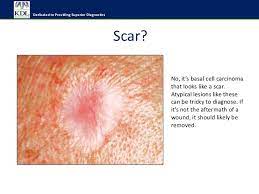 Actinic keratosis (ak) often looks like a small, rough, scaly patch on the skin. Do I Have Skin Cancer