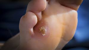 Dark spots on the skin of the soles of your feet may appear like it is a harmless occurrence. 10 Common Foot Problems And How To Manage Them Everyday Health