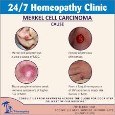 Image result for Merkel Cell Carcinoma