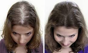 7 Cách Trị Hói Đầu Ở Nữ - Giúp Tóc Mọc Dài, Dày Nhanh
