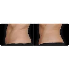 Coolsculpting® and coolsculpting® elite uses. Coolsculpting Consultation Med Spa And Laser Center Ochs Dermatology San Antonio Tx