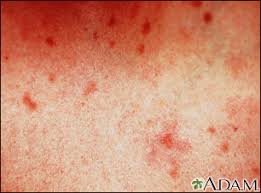 Image result for Urticaria pigmentosa children