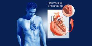 Voraussetzungen dafür sind die bestimmung nichtinvasiver und invasiver biomarker inklusive endomyokardbiopsie und polymerasekettenreaktion (pcr) auf kardiotrope substanzen. Myokarditis Risiko Nach Covid 19 Geringer Als Gedacht Us Studie