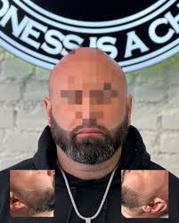 Expert Scalp Micropigmentation in NYC