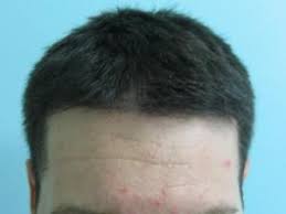 Natural hair transplant results with follicular unit extraction. Los Angeles Hair Transplant