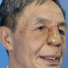 the result after 2 years of follow-up, oblique view.