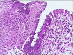 Maybe you would like to learn more about one of these? Squamous Metaplasia Of Uterine Cervix