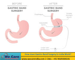 How Does Gastric Band Surgery In India Work In 2020 Gastric Band Sleeve Surgery Gastric Sleeve Surgery
