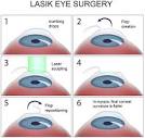 LASIK Eye Surgery · Top Eye Specialist | Best Rated NYC ...