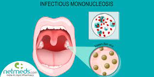 Mononucleosis: Causes, Symptoms And Treatment