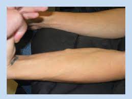 Figure 2 From Treatment Of A Symptomatic Forearm Muscle Herniation With A Mesh Graft Semantic Scholar