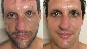 The pain level might be quite high and it's often a good idea to seek out medical attention to prevent scarring or infection. Scott S Scarring Story Acne Scar Treatment By Dmk