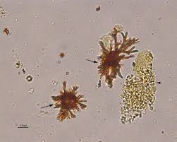 Urine Crystals Eclinpath Crystals Urinal Squamous
