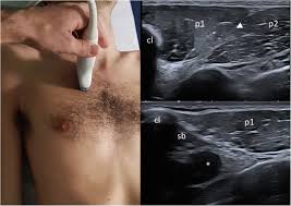 Poland syndrome is a health condition in which the muscles present on one side of the body are either missing or. Consensus Based Recommendations For Diagnosis And Medical Management Of Poland Syndrome Sequence Orphanet Journal Of Rare Diseases Full Text