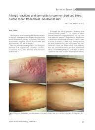 Pdf Allergic Reactions And Dermatitis To Common Bed Bug Bites A Case Report From Ahvaz Southwest Iran